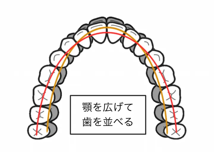 歯列の幅の拡張