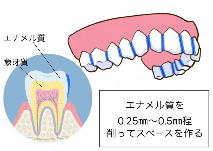 歯を少し削って、広げる処置