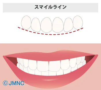 スマイルライン